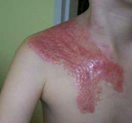 Rana pooparzeniowa gotowa do terapii Codopressem®