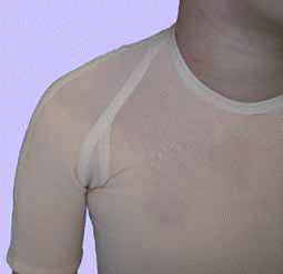 Wyrób Codopress® założony na wyleczoną ranę pooparzeniową