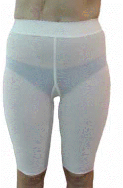 Wyrób Codopress® założony na wyleczoną bliznę pooparzeniową