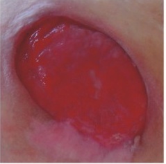 leczenie_ran_przewl_w_srod_wilgot_13