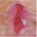 leczenie_ran_przewl_w_srod_wilgot_5