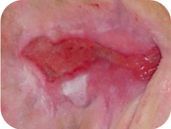 Odleżyny_html_19db5aad