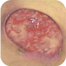 Odleżyny_html_21bfedef