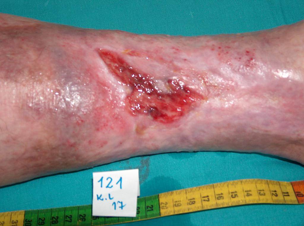 Fot 4. Owrzodzenie żylne w końcowej fazie gojenia (archiwum własne autorki)