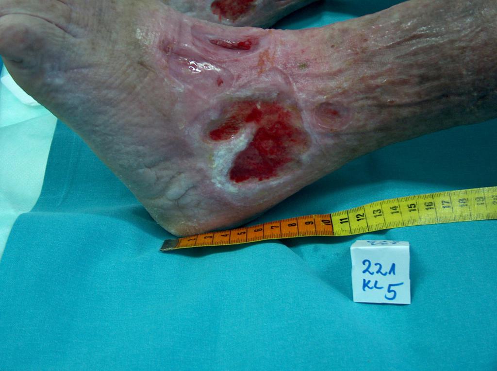 Fot 3. Owrzodzenie żylne w okolicy stawu skokowego (archiwum własne autorki)