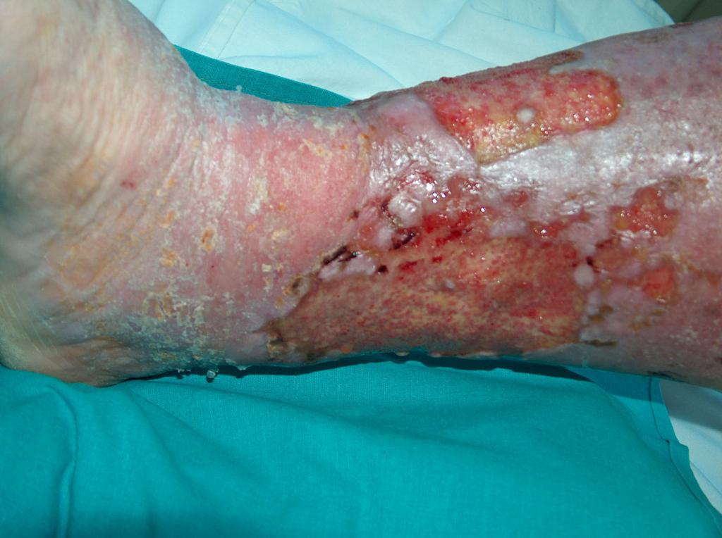 Fot. 1. Owrzodzenie żylne okrężne (archiwum własne autorki)