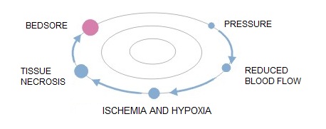 Odleżyny_html_bb2fc6f