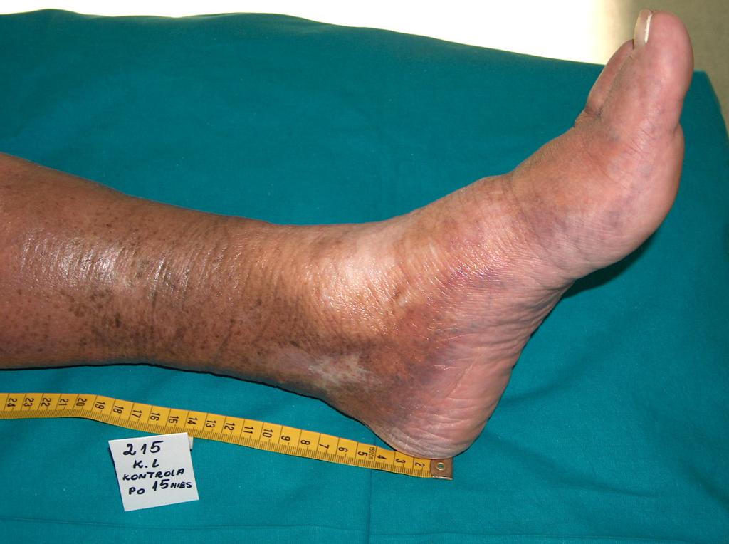 Fot. 9 Wyleczone owrzodzenie żylne, na skórę stosowano emolienty (archiwum własne autorki)